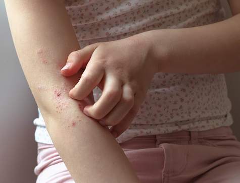 eczema